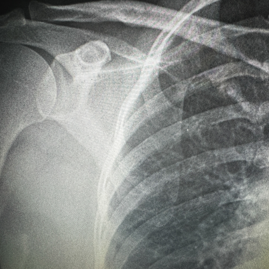 x-ray of shoulder